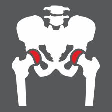 Avn Hip Joints