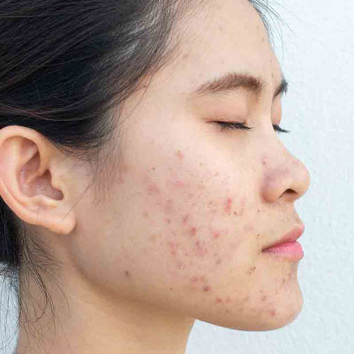 Acne Treatment | Global Health