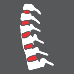 Cervical Spondylitis